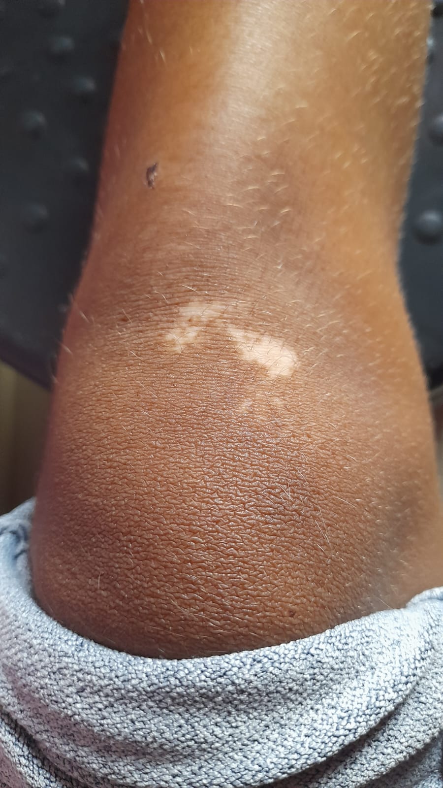 Understanding Vitiligo: Causes, Treatment, and What to Expect